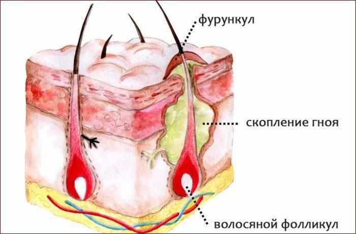 Строение фурункула