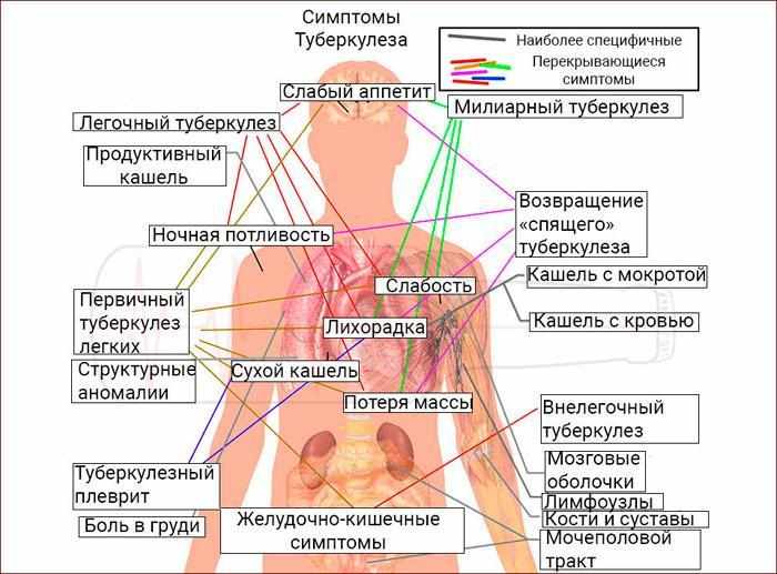 Симптомы туберкулёза