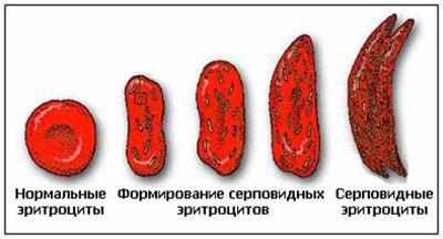 Эритроциты при анемии