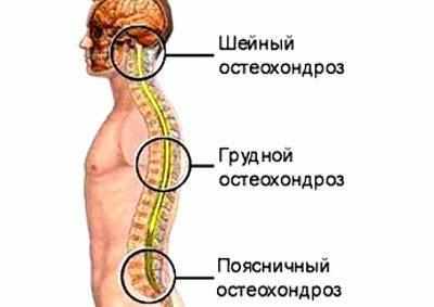 Локализация остеохондроза