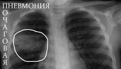 Пневмония на рентгене