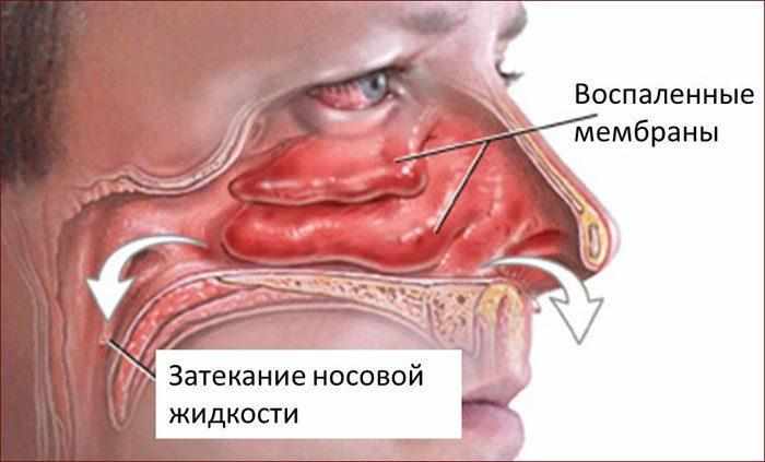 Затекание жидкости в носоглотку