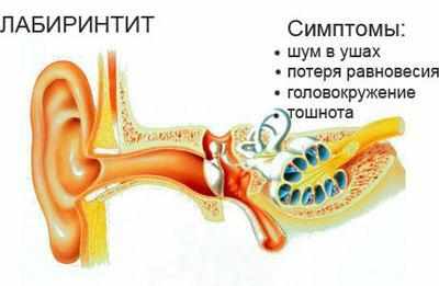 Проявление лабиринтита