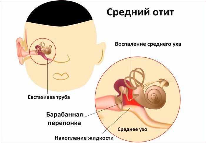 Признаки отита среднего уха