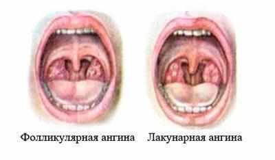 Виды ангины