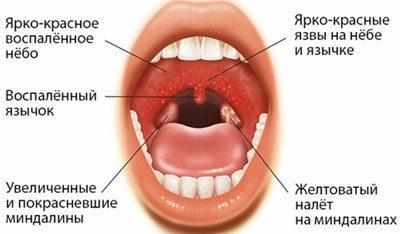 Признаки ангины