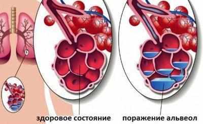 \жидкость в альвеолах
