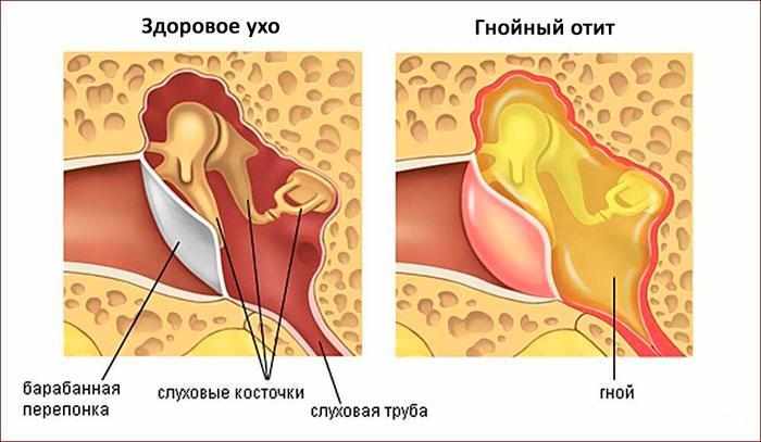 гнойный отит