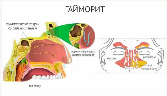 признаки гайморита