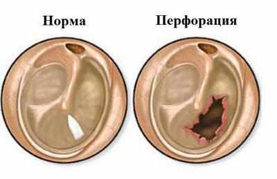 Перфорация барабанной перепонки