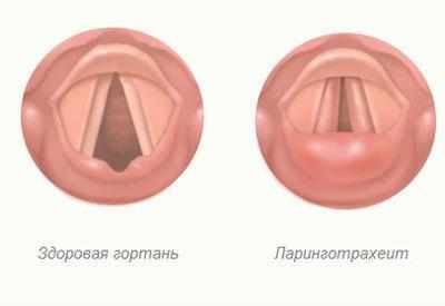 Проявление ларинготрахеита