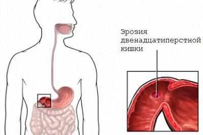 Эррозия кишечника