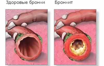 Воспаленные бронхи