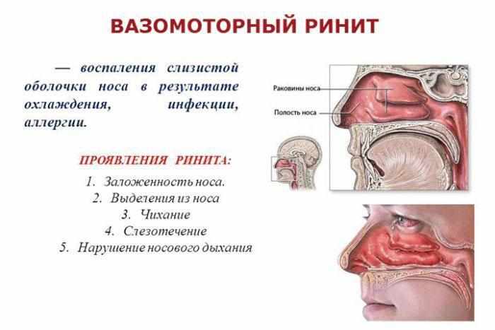 Симптомы ринита