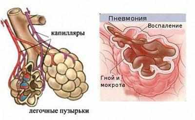 Альвеолы при пневмонии