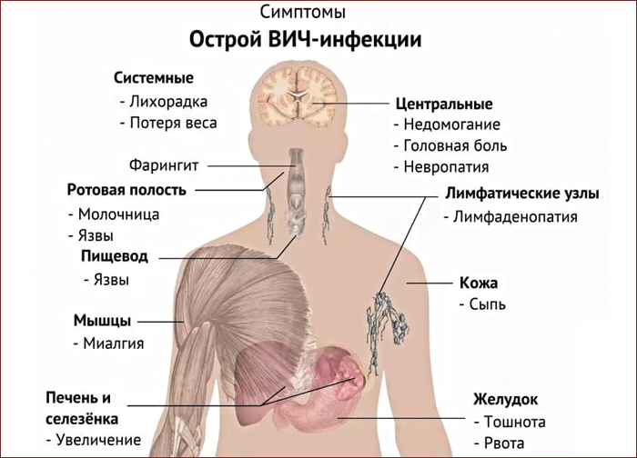 Симптомы острой ВИЧ-инфекции