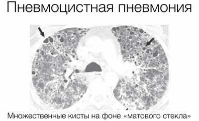 Пневмоцистная пневмония