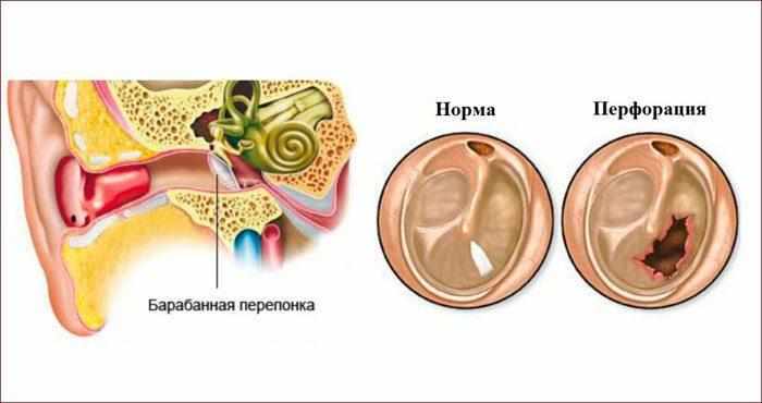 Образование ушной пробки