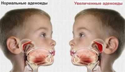 Разрастание аденоидов