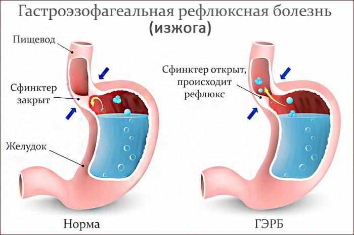 симптомы изжоги