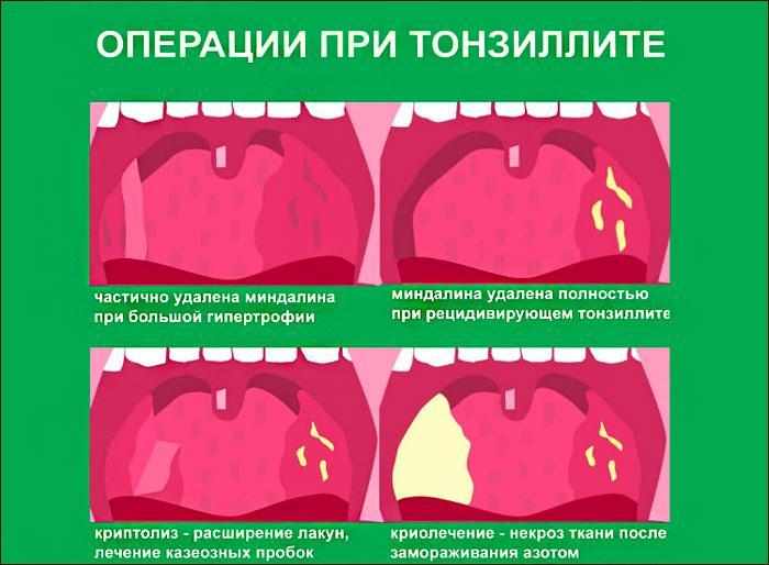 Операции при тонзиллите