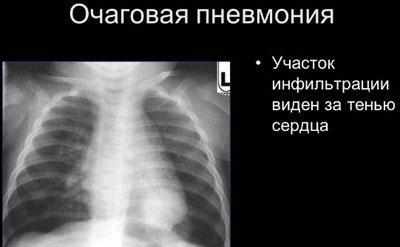 Очаговая пневмония на рентгене