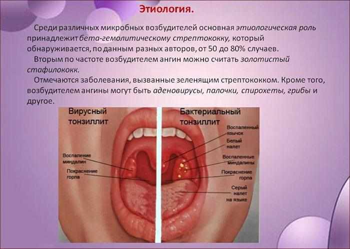 Этиология ангины