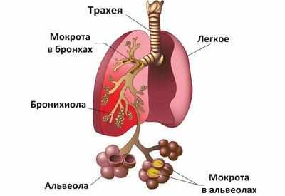 Легкие при пневмонии