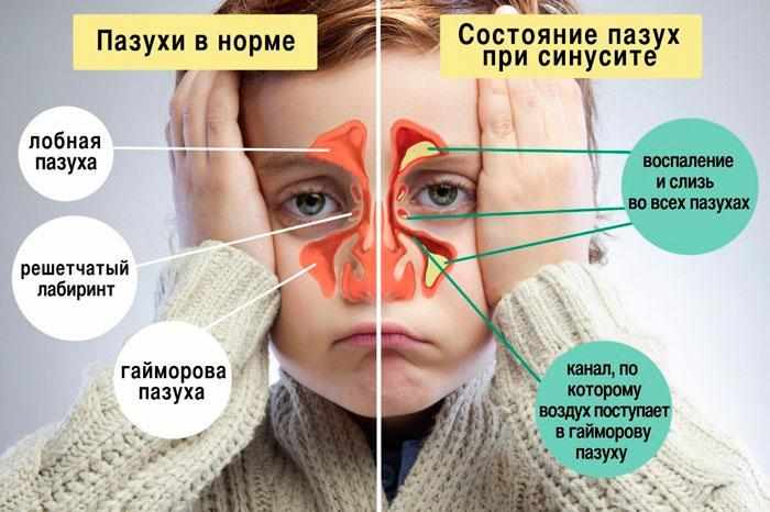 Пазухи при синусите