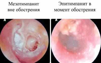 Эпитимпанит и мезотимпанит