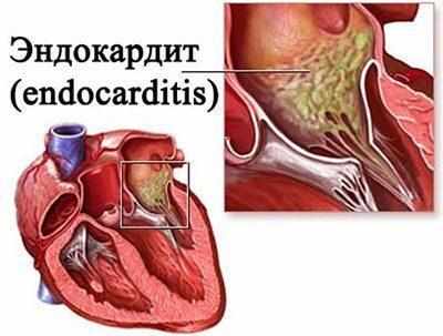 Сердце при эндокардите