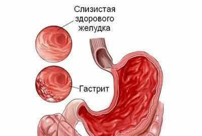 Желудок при бронхите