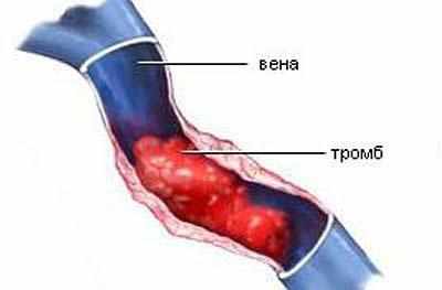 Образование тромба