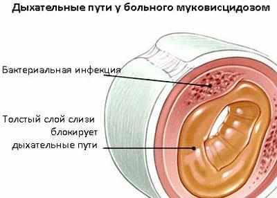 Заболевание муковисцидоз