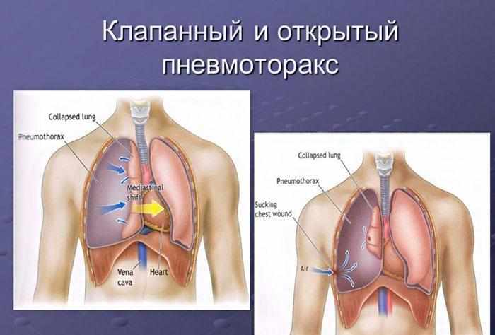 Изображение клапанного/открытого пневмоторакса.