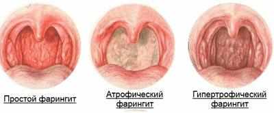 Виды фарингита
