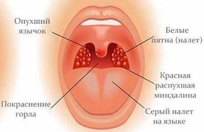 Признаки тонзиллита