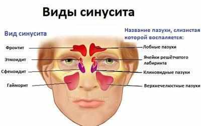 Виды синусита