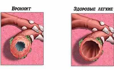 Воспаленные бронхи