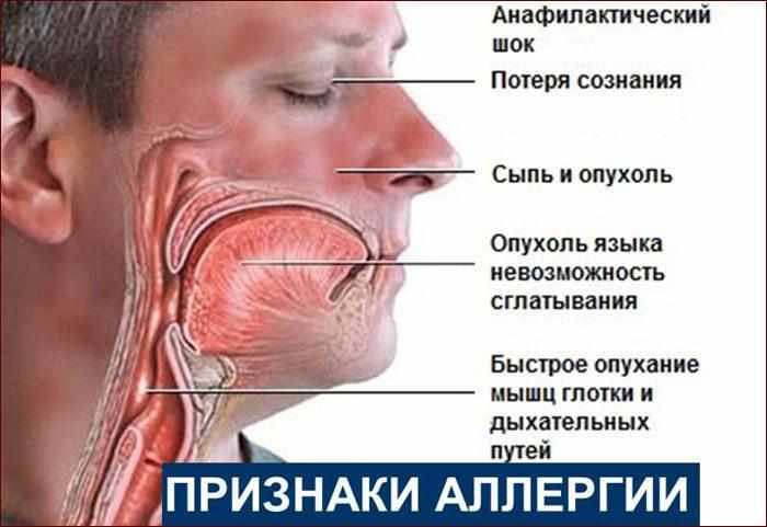 Признаки аллергии