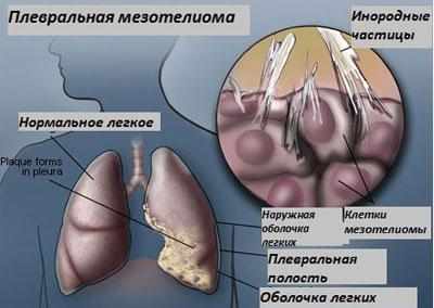 Мезотелиома легких