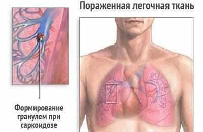 Саркоидоз легких