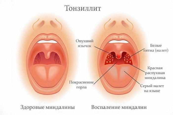 Симптомы тонзиллита