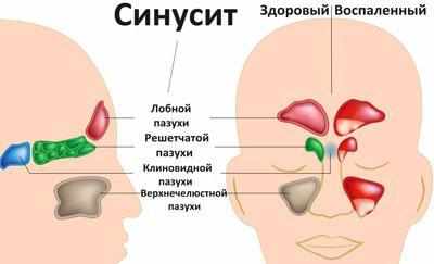 Виды синуситов