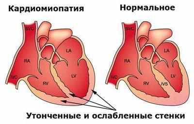 следствие кардиомиопатии