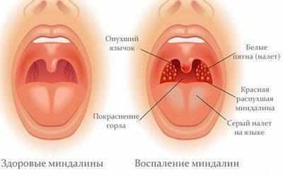 Симптомы тонзиллита