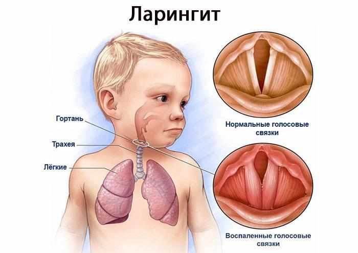 Симптомы ларингита