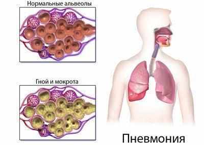 Альвеолы при пневмонии