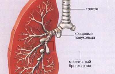 Проявление бронхоэкстаза