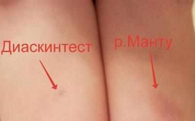 Манту и диаскинтест